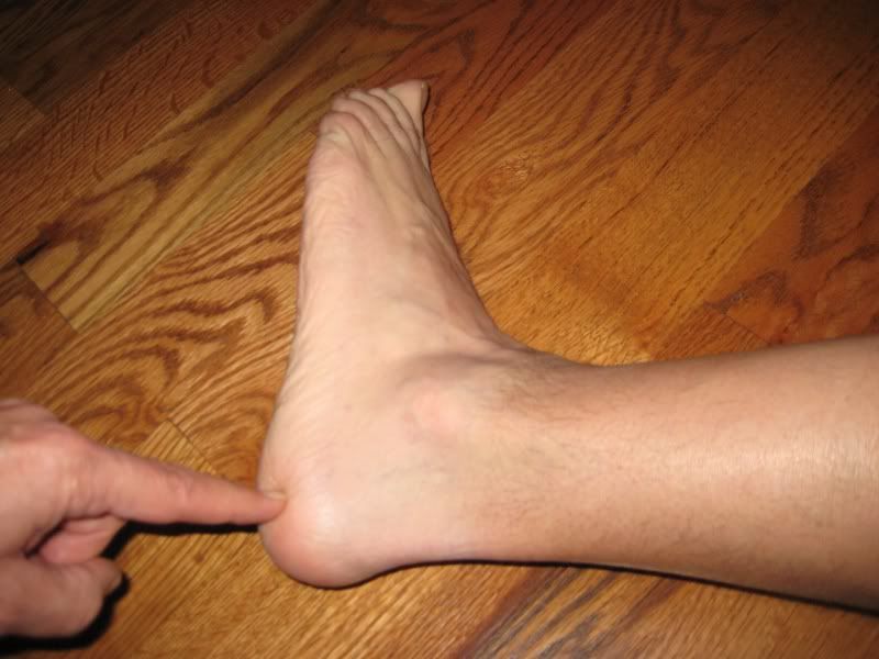 lateral-heel-pain-for-dr-splichal-kind-of-barefoot